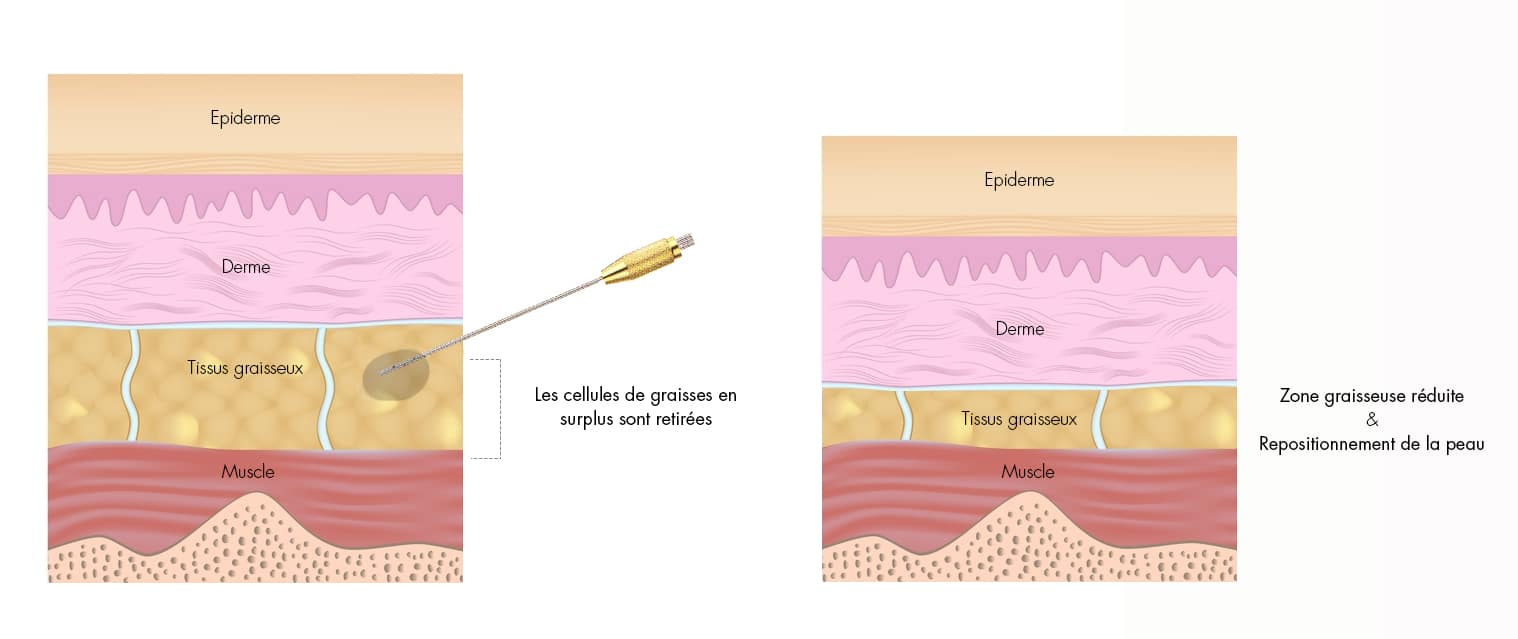 LIPOSUCTION OR LIPOASPIRATION OF THE BELLY Docteur Diacakis