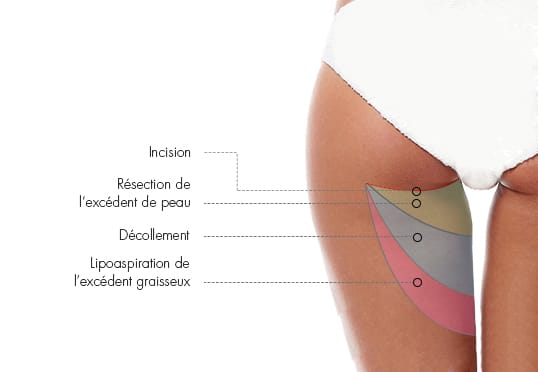 Inner Thigh Liposuction Incisions: Where Are They Made?