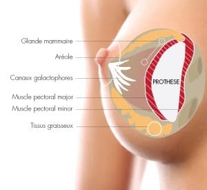 Augmentation mammaire par le Docteur Diacakis