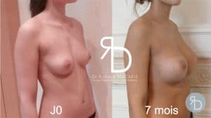 Résultats de l'augmentation mammaire du Docteur Diacakis sur une patiente