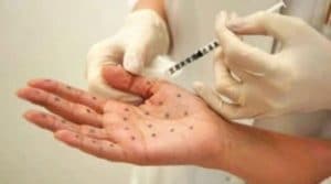 PALM HYPERHIDROSIS TREATMENT OF EXCESSIVE HAND PERSPIRATION Docteur Diacakis