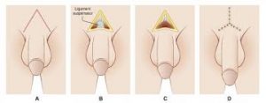 SURGICAL PENOPLASTY OR FAT INJECTION LENGTHENING AND THICKENING PENOPLASTY Docteur Diacakis
