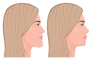 image vectorielle représentant une femme avec un menton en galoche avant et après chirurgie