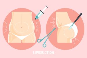 Une image vectorielle de couleur rose montrant l'aspiration de la graisse du ventre avec une seringue. La graisse est ensuite injectée dans les fesses pour les rendre galbés et volumineux.