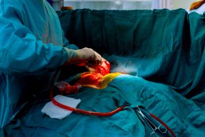Un chirurgien dans une tenue bleue effectuant une opération. Une tube pleine de sang est posée sur le patient.