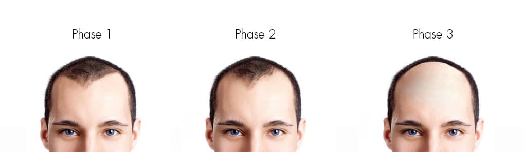 les tapes de la calvitie