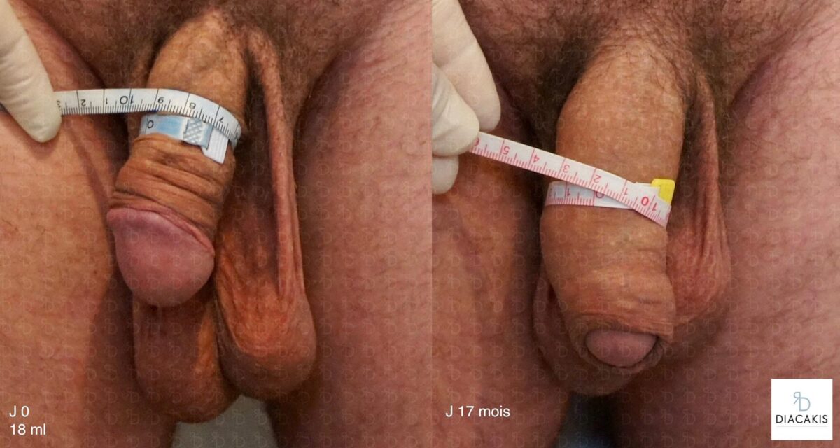 Comment agrandir son penis ? 5 penoplastie paris augmentation du penis docteur diacakis 3.jpg 1
