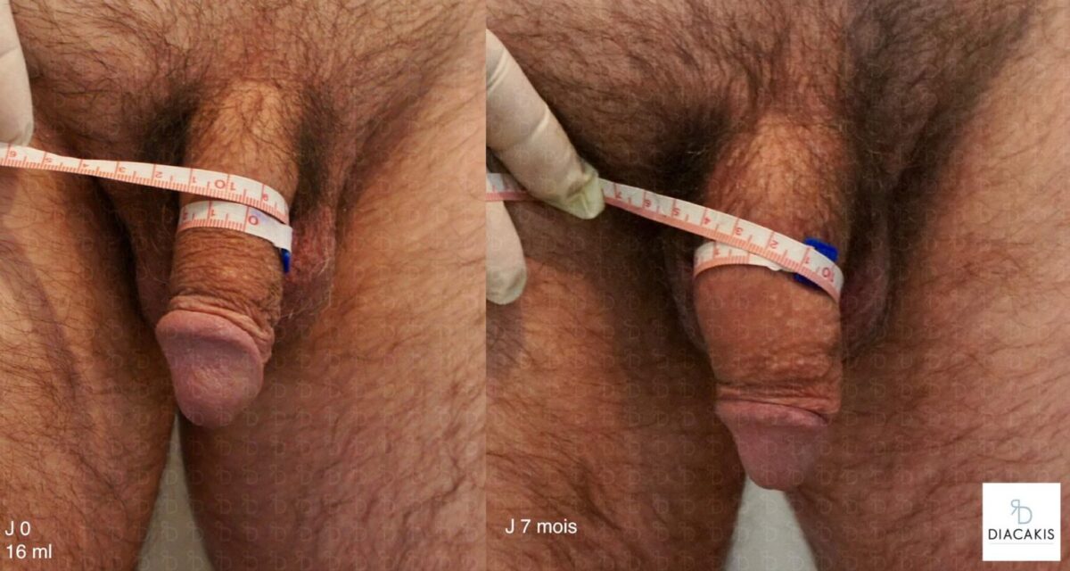 Comment agrandir son penis ? 3 penoplastie paris augmentation du penis docteur diacakis 6 1536x819.jpg 1