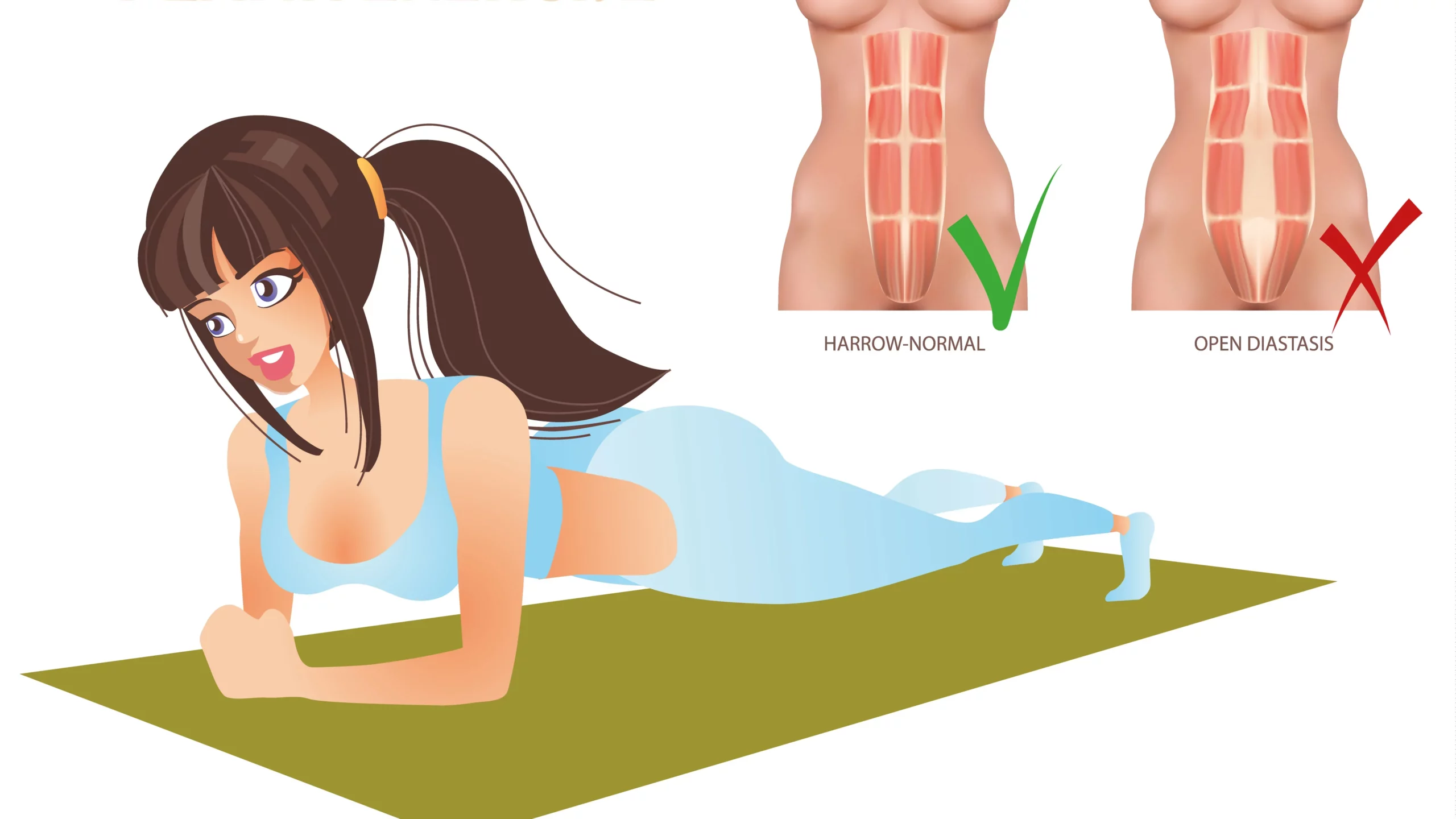 Diastasis : comment savoir si c’en est une ? 2 123537309 m edited scaled