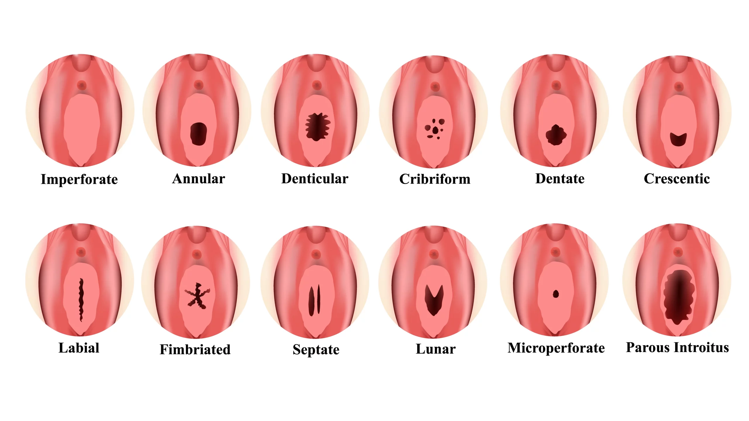 Au bout de combien de temps l'hymen se referme ? 2 Illustration des différents types d'hymen femme