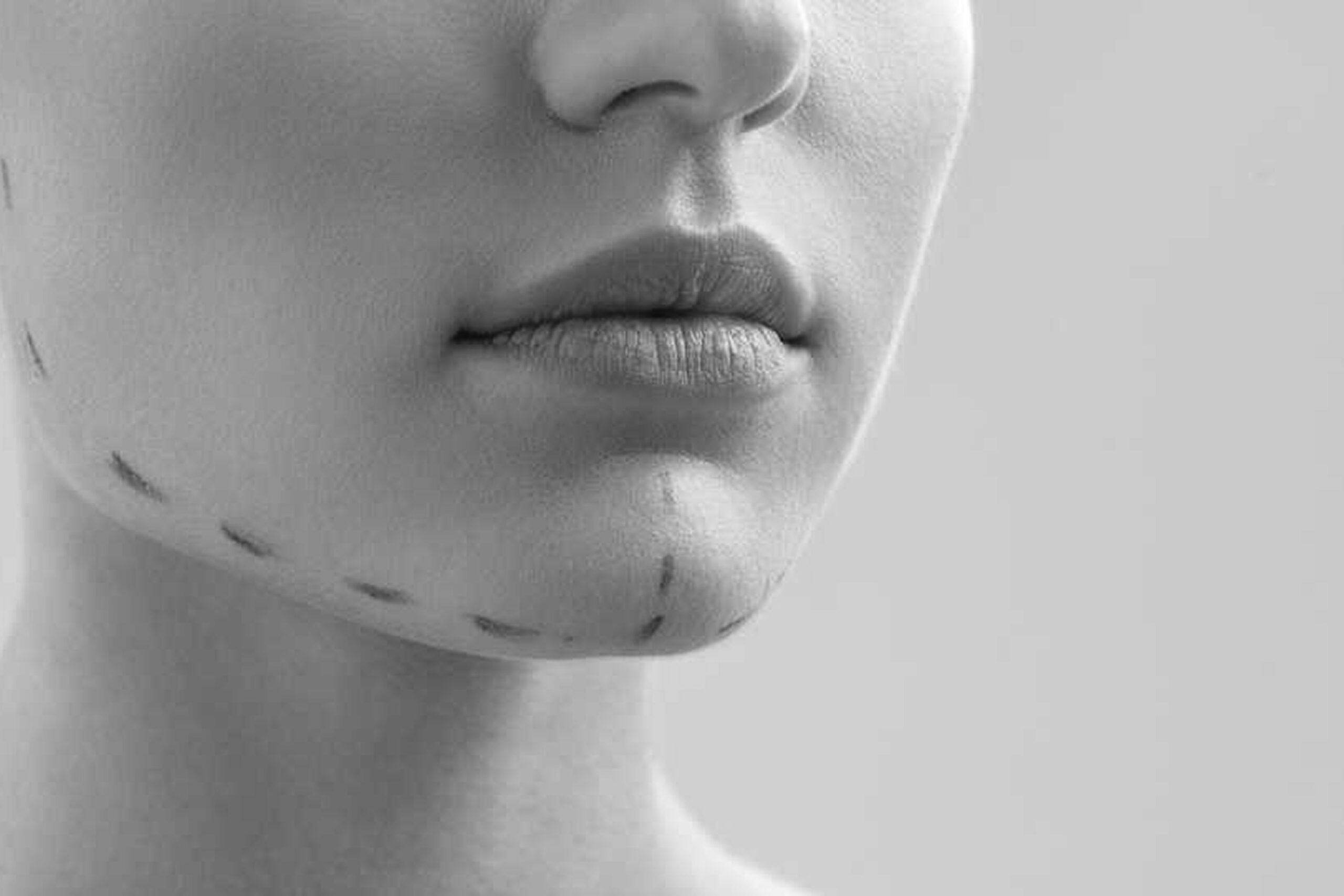 woman marked out cosmetic surgery 1 3 scaled